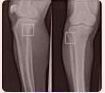 Tibia / Fibula